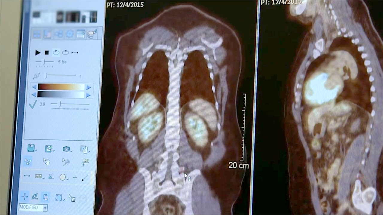 Lung cancer: what are risks and symptoms?
